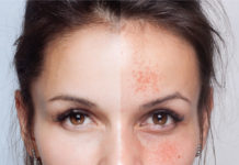 Gesichtshaut vor und nach einer kosmetischen Behandlung ( Depositphotos.com/ Whiteshoes911)