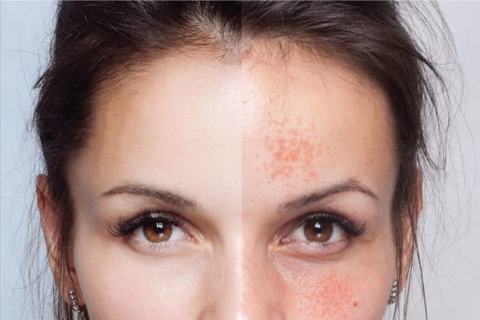Gesichtshaut vor und nach einer kosmetischen Behandlung ( Depositphotos.com/ Whiteshoes911)