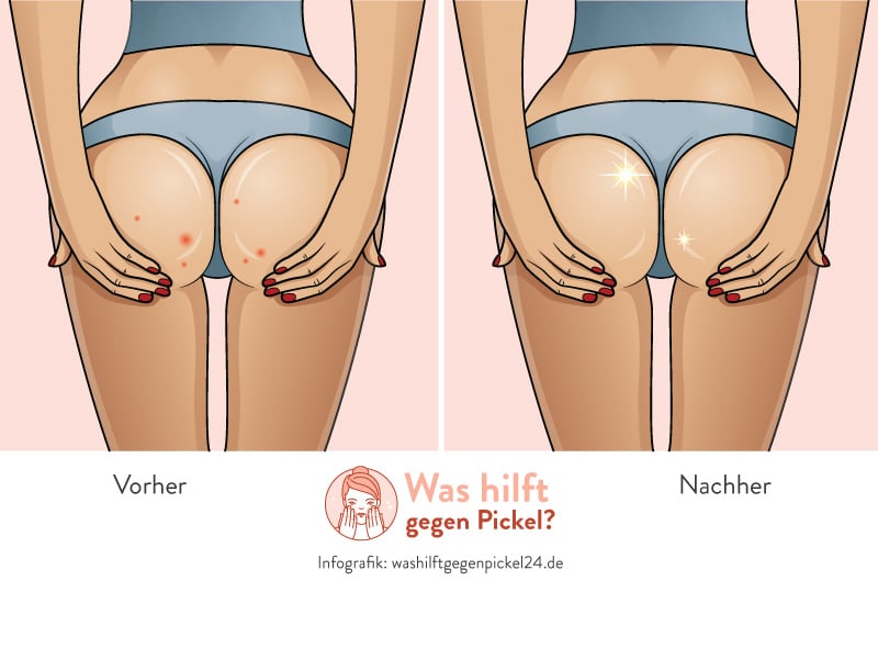 Pickel am Po - Vorher/Nachher Infografik (Copyright: Washilftgegenpickel24.de)