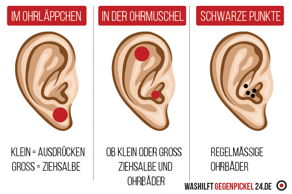 Infografik - Pickel im Ohr - Wie behandeln