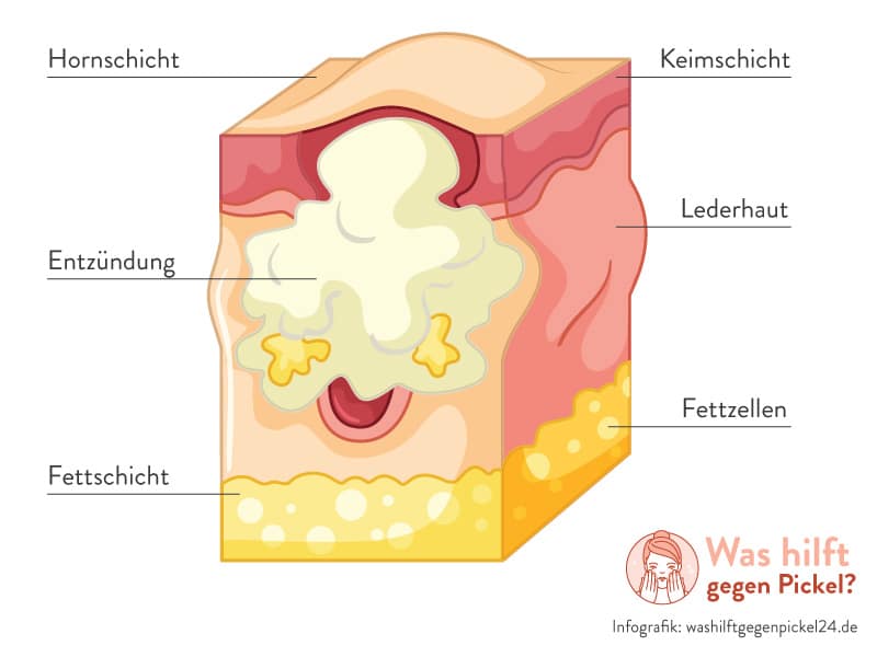 Pickel unter der Haut - Unterirdischer Pickel - Infografik von washilftgegenpickel24.de